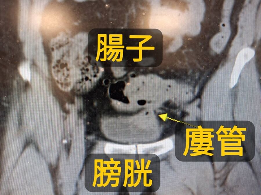 「泡泡尿」藏致命危機！醫一看嚇壞：腸子接到膀胱了