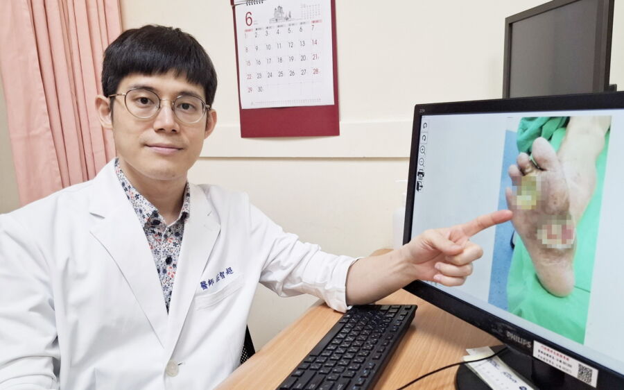 圖／莊智超醫師指向見骨傷口，提醒糖尿病患者勿忽略小傷，以避免導致嚴重感染。（衛生福利部臺北醫院提供）