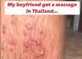 慘了！泰國按摩後腿爛了　一覺醒來「腿爆膿瘡」畫面曝光