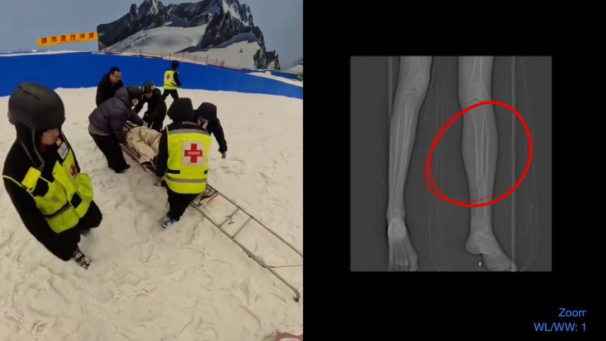 圖/女子在加速時身體重心不穩,下一秒便向前傾倒,腿部遭扭轉,當場痛苦倒地,隨後即被送往醫院救治。(翻攝 xinpengjilin Instagram)