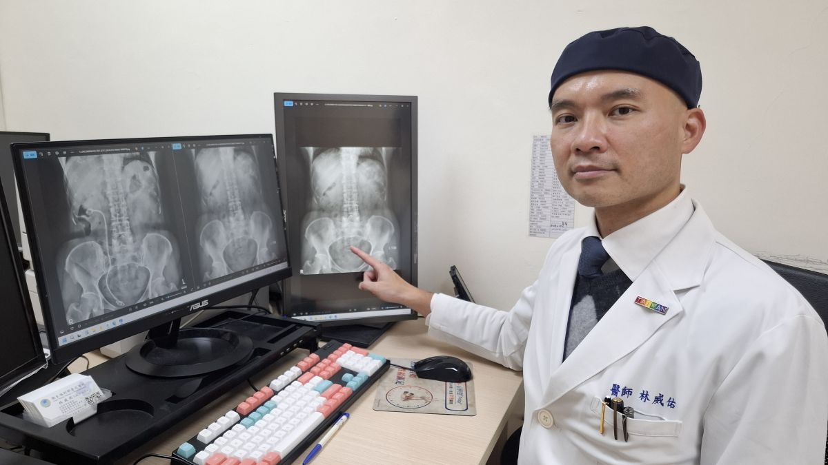 臺北醫院新技術助尿路結石患者擺脫反覆手術 臺北醫院新技術助尿路結石患者擺脫反覆手術