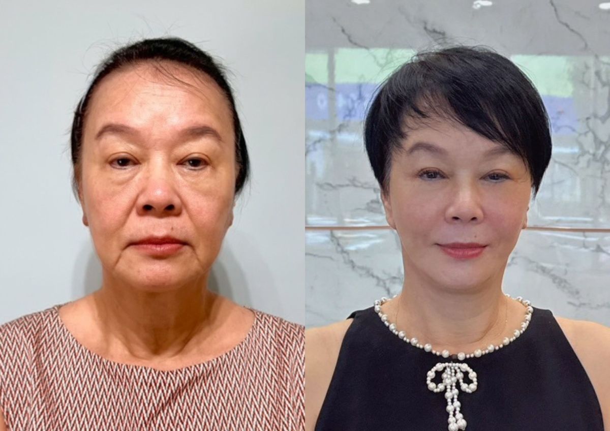 圖/布蘭妮接受專業團隊評估前後對照,展現自信好氣色。(陽光璨亮整形外科團隊提供)